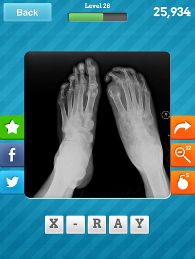  X-ray 